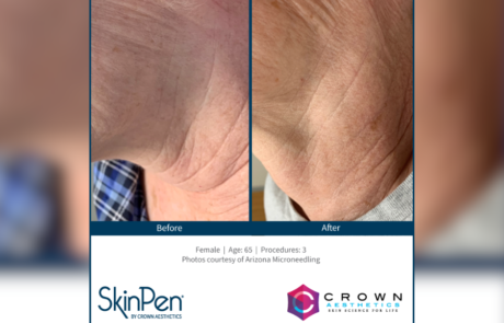 Spend It In Glendale AZ – SkinVolution Laser and Vein Center 4